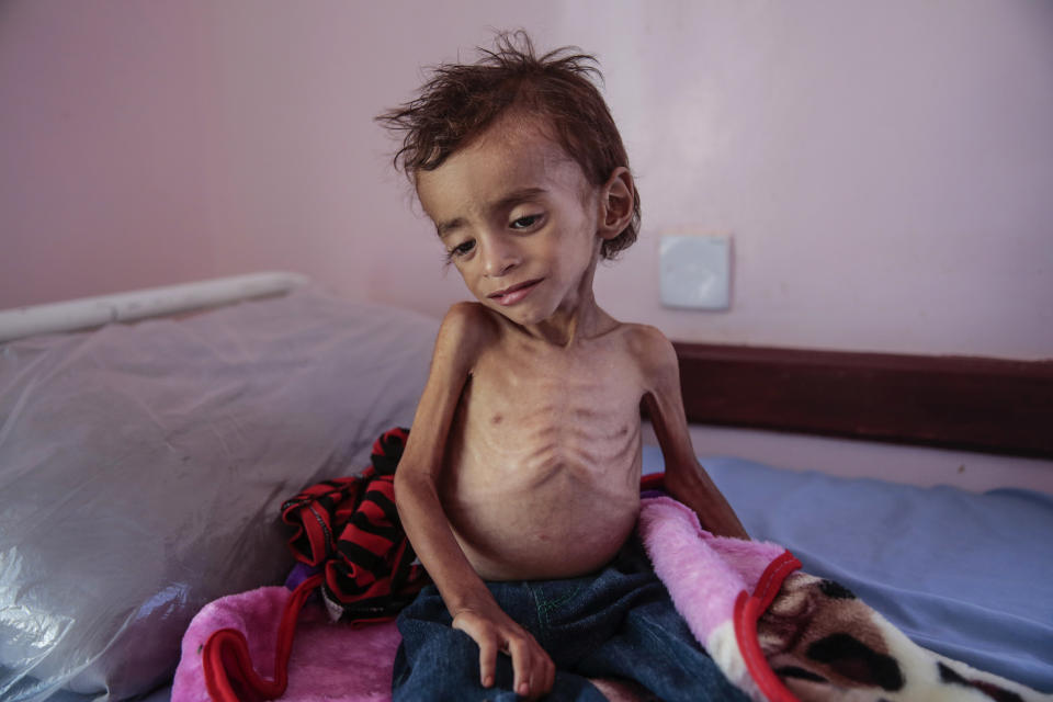 A malnourished boy sits on a hospital bed at the Aslam Health Center, Hajjah, Yemen on Oct. 1, 2018. (AP Photo/Hani Mohammed, File)