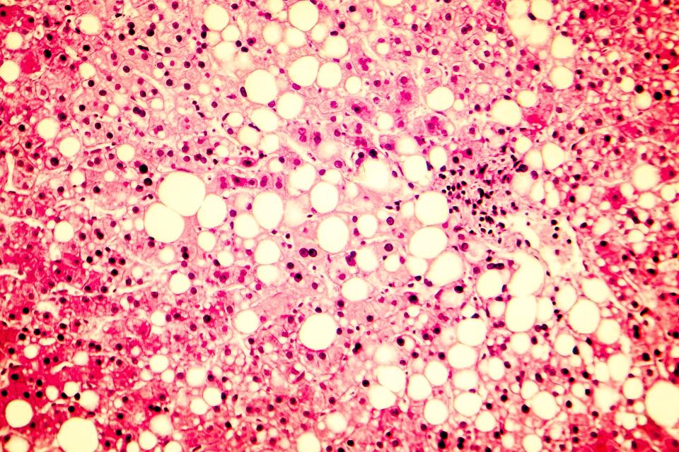 fatty liver tissue under a microscope