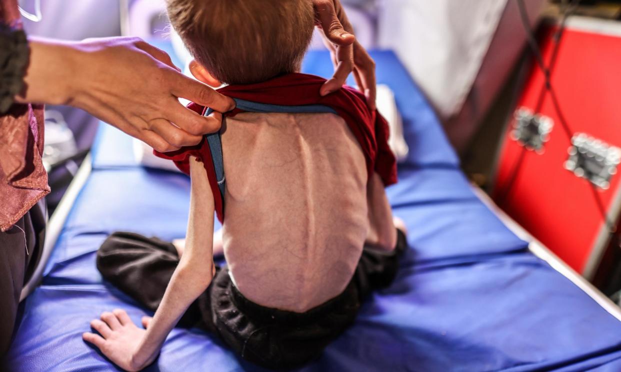 <span>A nine-year-old Palestinian boy experiencing malnutrition, evacuated from northern Gaza to an International Medical Corps field hospital in Rafah.</span><span>Photograph: Anadolu/Getty Images</span>