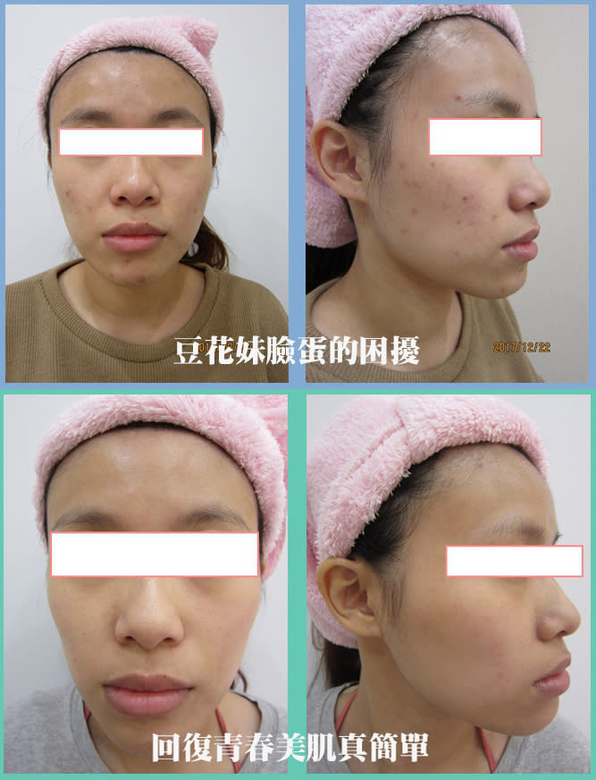 適合亞洲人的超皮秒雷射：解決肌膚痘疤、刺青、斑點等問題
