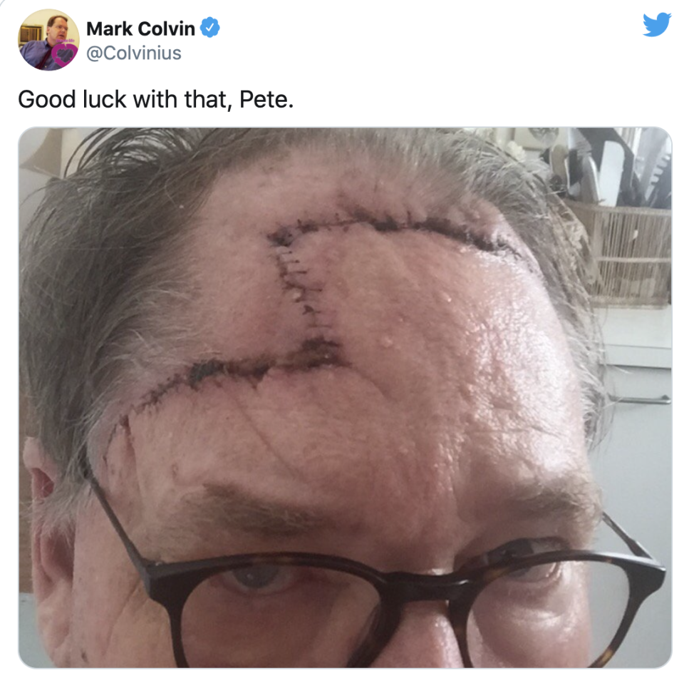 Close-up of Mark Colvin's melanoma removal scarring