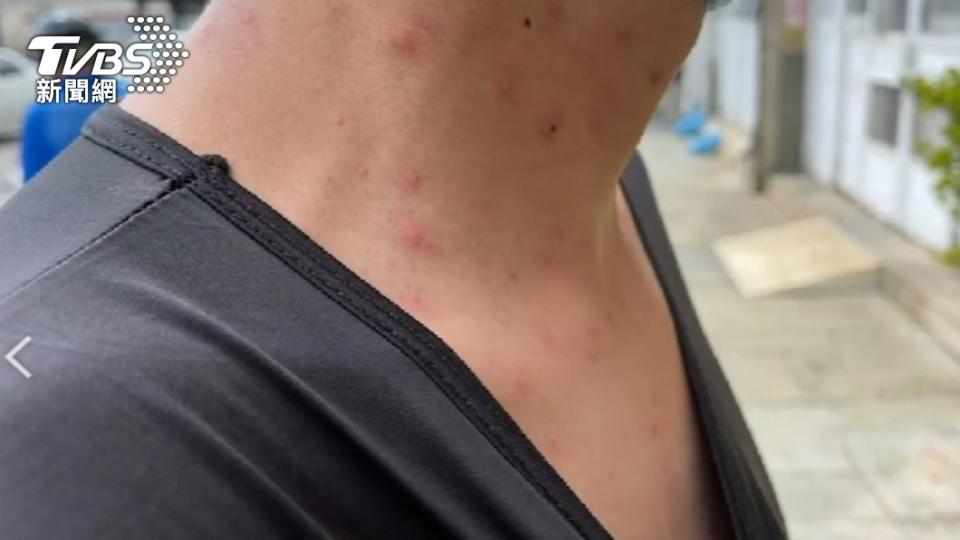 澎湖近日許多民眾發生皮膚出紅疹、搔癢狀況。（圖／TVBS）