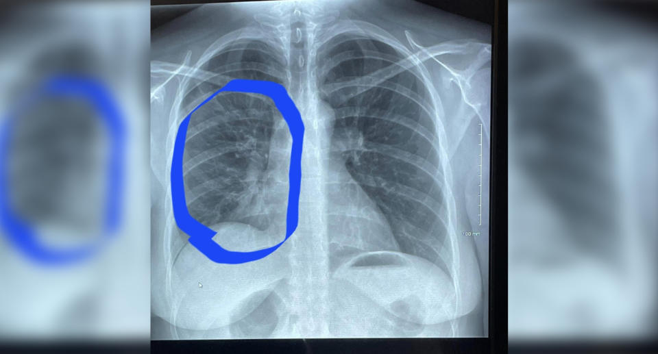 母親の肺のX線写真。 出典: ケネディのニュースと写真 