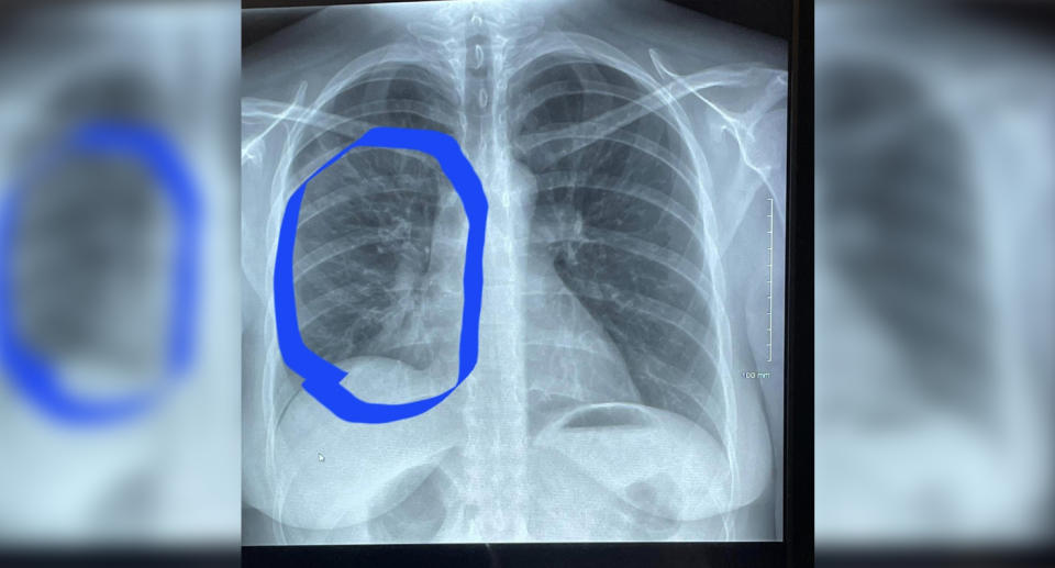 X-Ray Of Maternal Lungs.  Source: Kennedy News And Images 