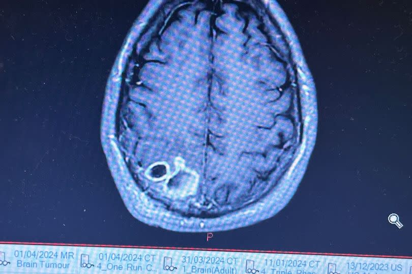 The mass inside Callum's skull