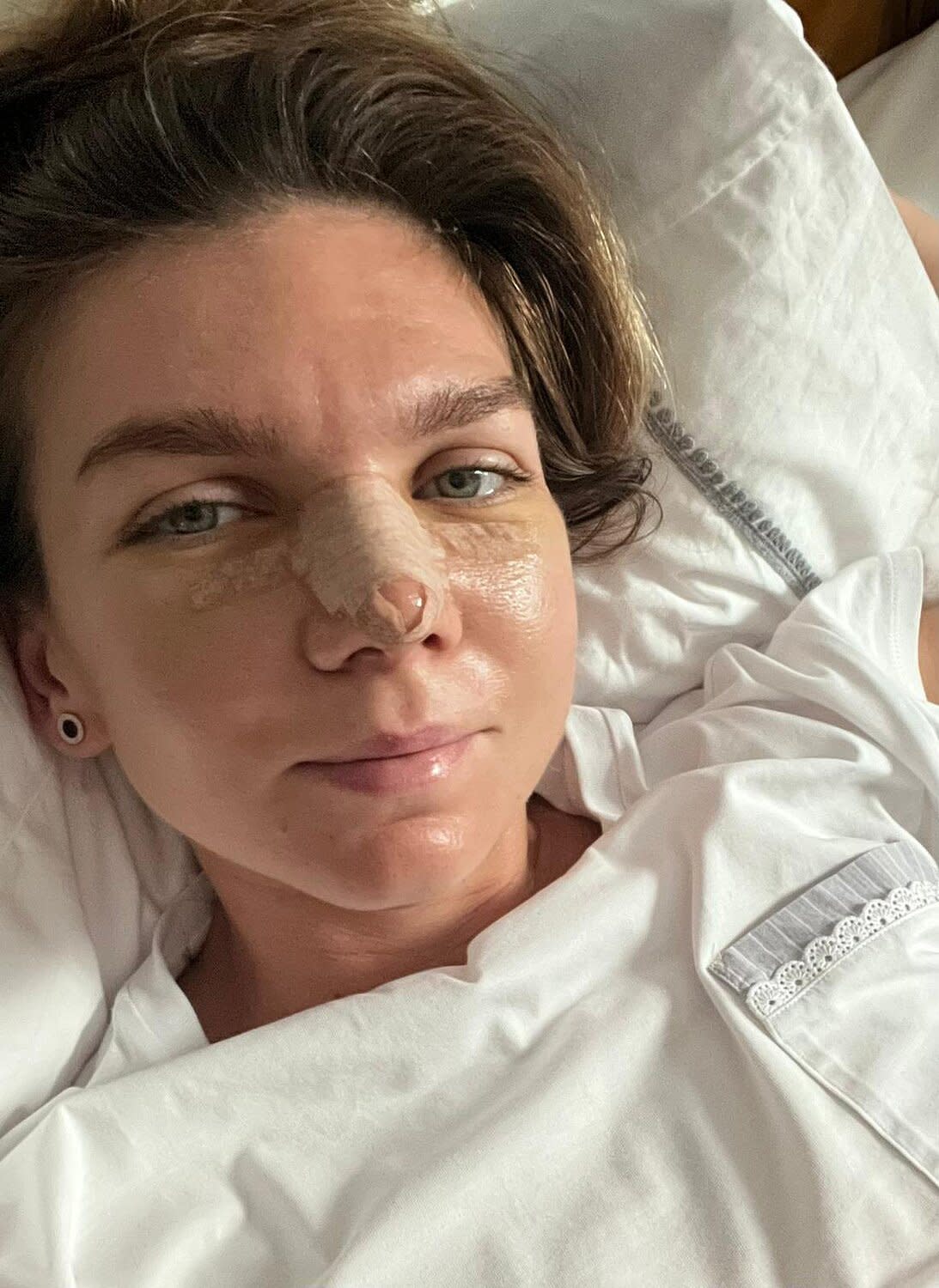 Tennis Champ Simona Halep Undergoes Nose Surgery for Breathing and Aesthetics: ‘I did not like my nose at all’