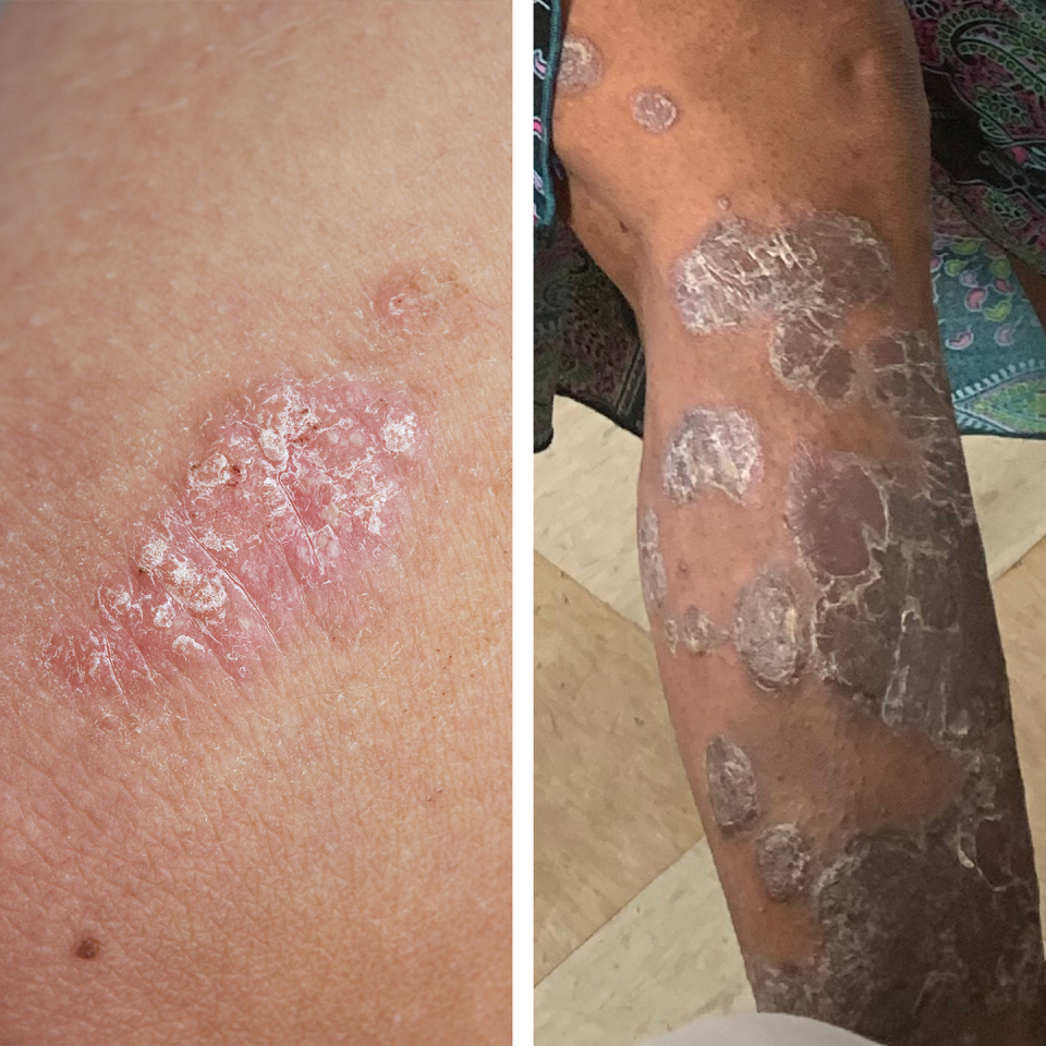 psoriasis rash identification picture