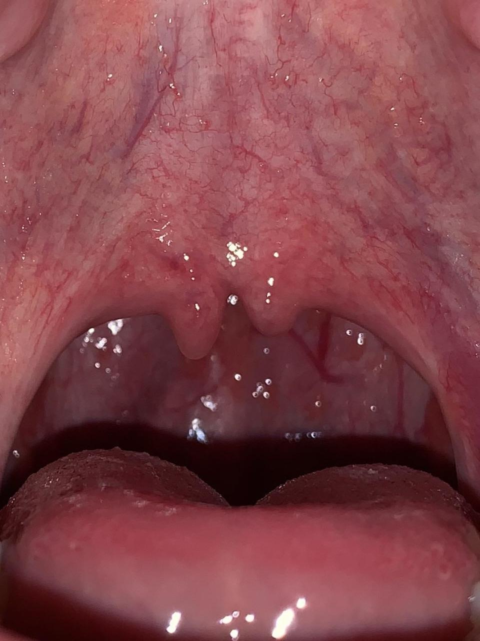 A bifid uvula