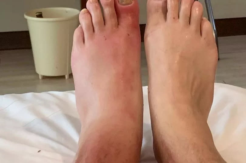 Diabetic grandad wins travel insurance battle after toe infection cut holiday short