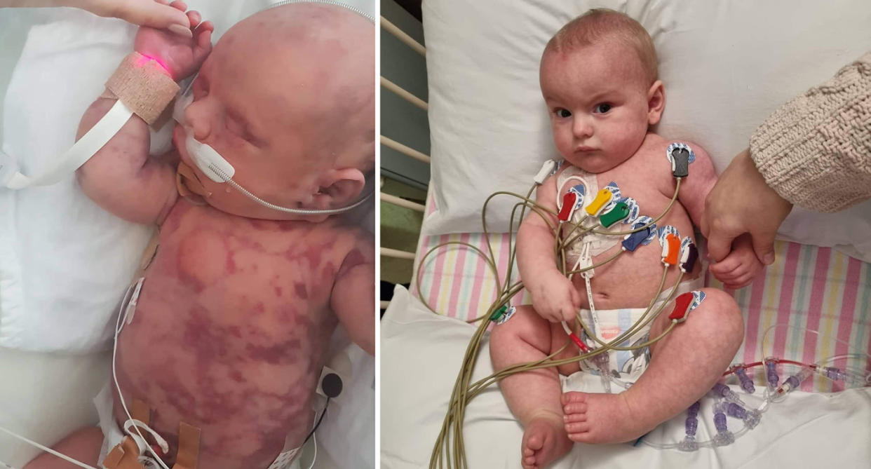 Baby Ashton is covered in bruises as he lies in a hospital bed with a tube connected to his nose.