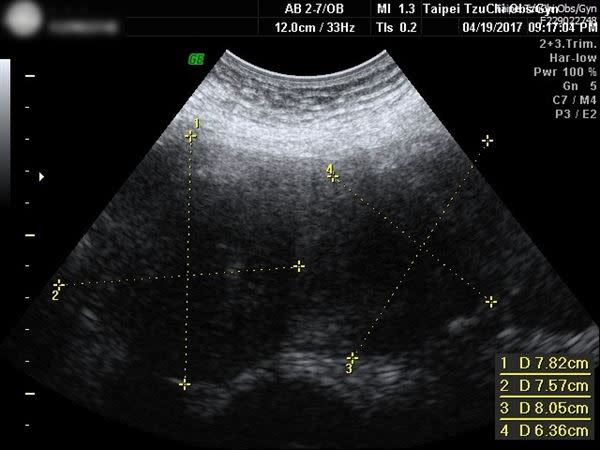 超音波影像顯示，患者陳小姐子宮內有許多巨大的子宮肌瘤（黃色十字範圍）。（圖片／台北慈濟醫院提供）