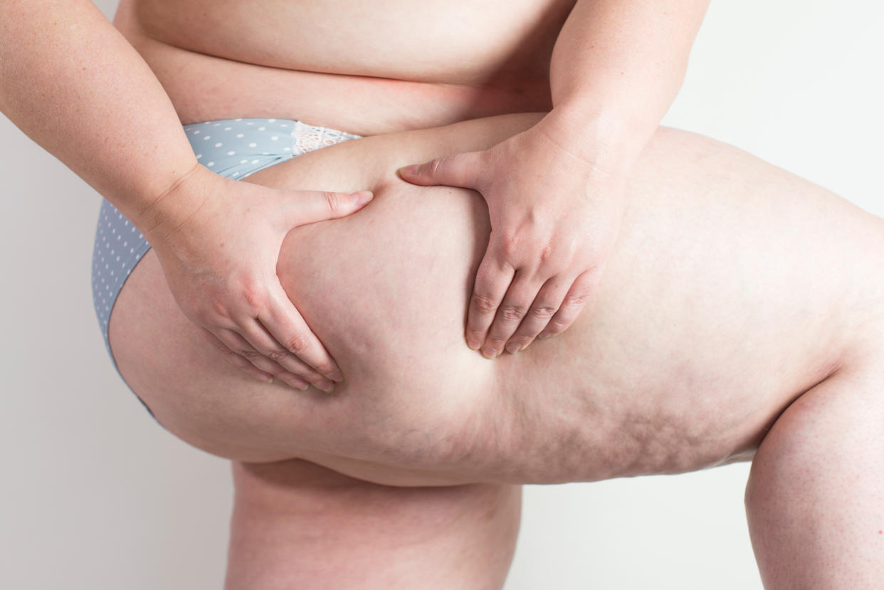 One man details the devastating effect fat shaming an have. [Photo: Getty]