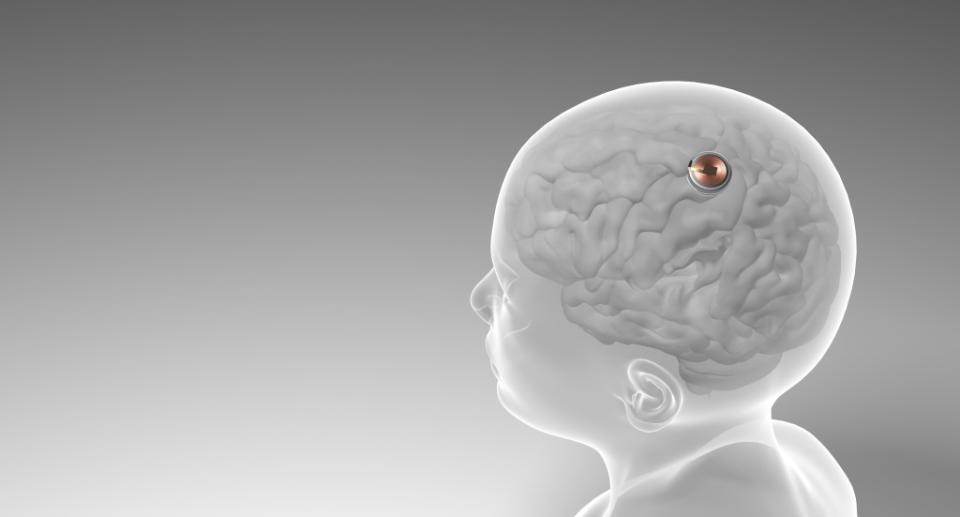Neuralink has won FDA approval to implant a brain chip into a second patient, according to a report on Monday. Getty Images/iStockphoto