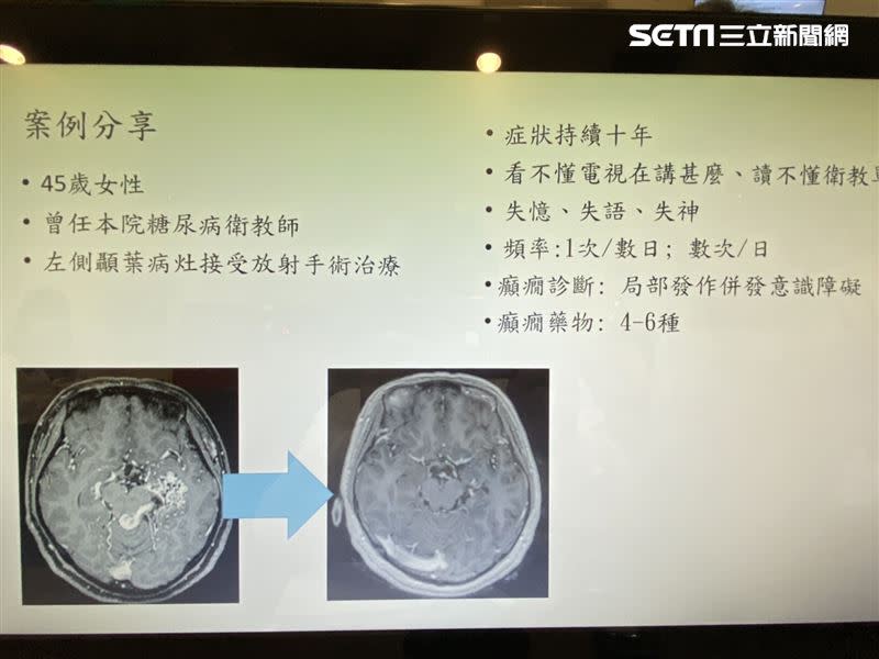 45歲擔任衛教師的程姓女子，前幾年前開始出現失語及失憶症狀，檢查後才知是癲癇，並在左腦發現一個動靜脈畸形瘤。（圖／記者簡浩正攝影）