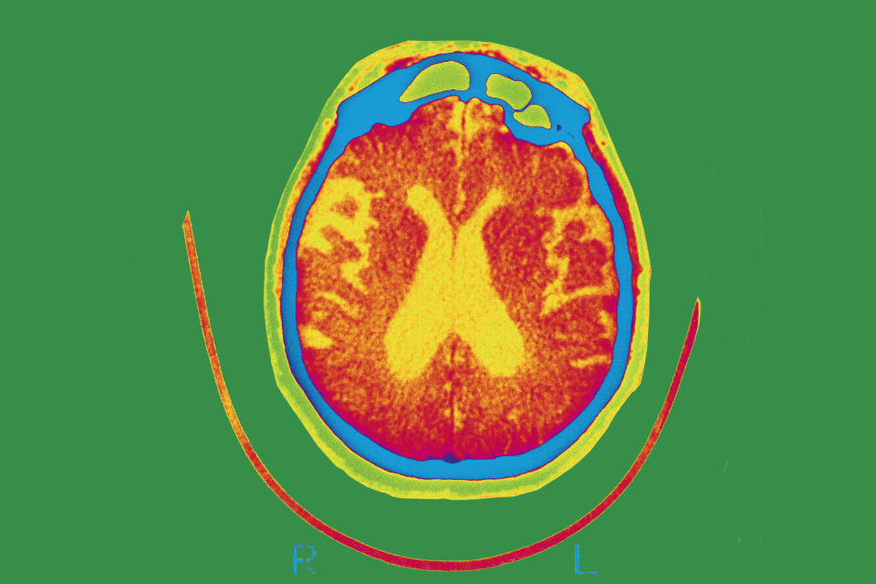 Scan of the brain of a patient affected by Alzheimer's disease. (BSIP / Universal Images Group via Getty Images)