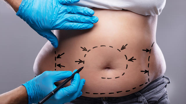 Tummy Tuck Before and After: Top Surgeon Weighs In