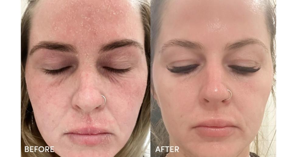 Before and after photos of woman with dry skin