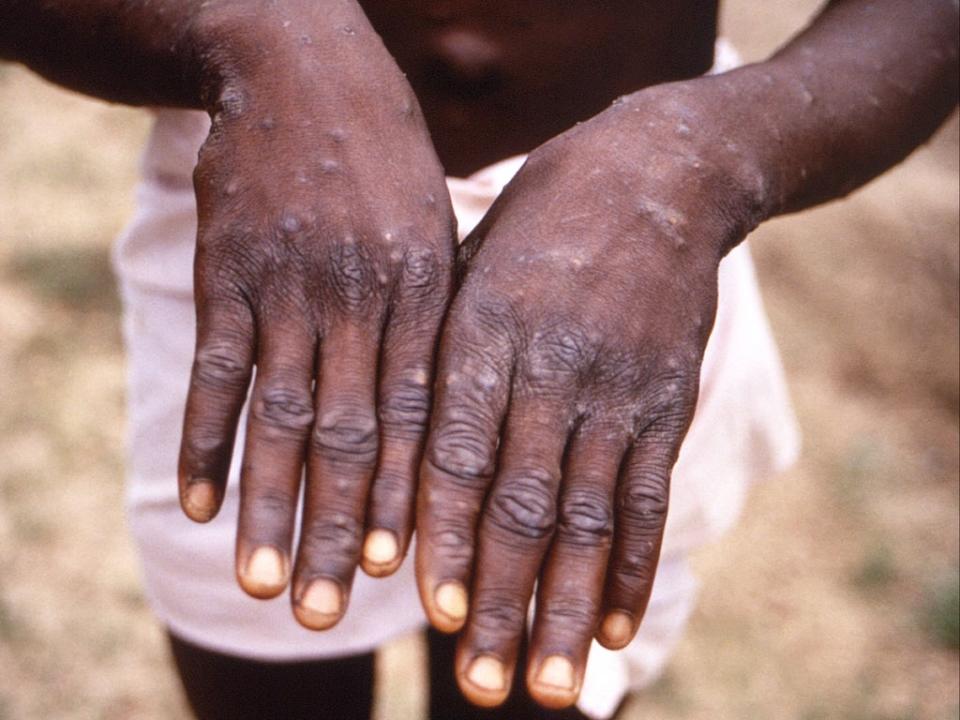 A case of monkeypox (via REUTERS)