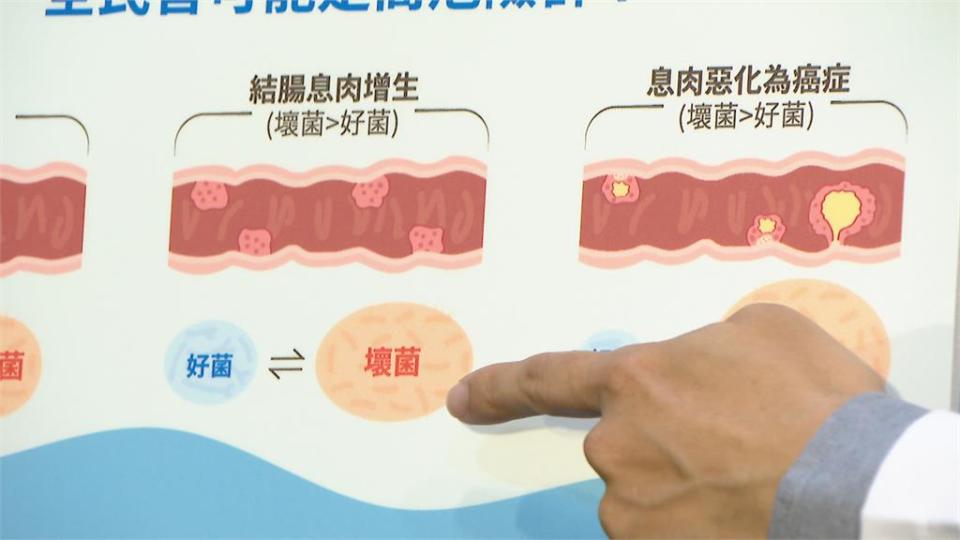 「癌王」大腸癌怎預防？　醫師籲：多喝優酪乳　保腸道健康