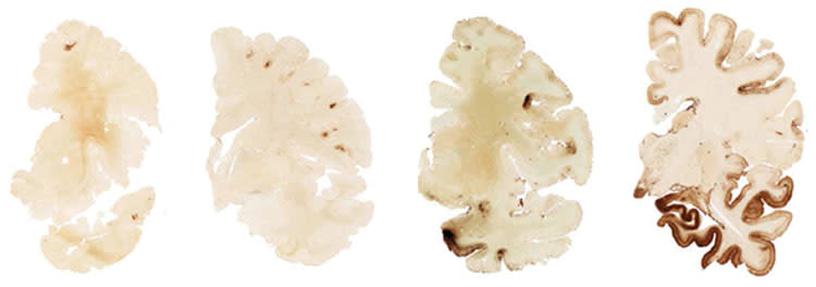 The ­stages of CTE, from 1 to 4. The damage at stage 1 may seem minimal but can have profound effects.