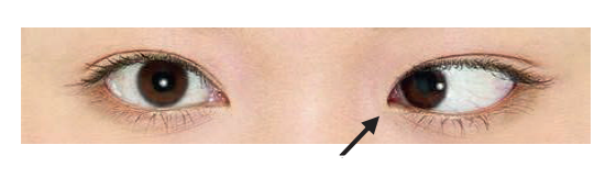 Esotropia in the left eye (Photo: Family Health Service, Department of Health)