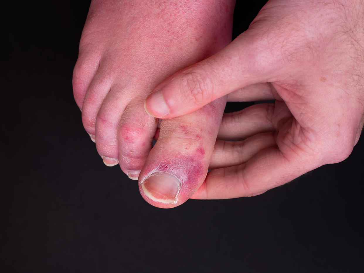 Scientists have uncovered what they believe causes COVID toe. (Getty Images)