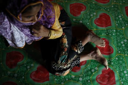 Begum, a Rohingya rape victim, shows her scars as she poses for a picture in Teknaf, Bangladesh, June 25, 2018. REUTERS/Mohammad Ponir Hossain