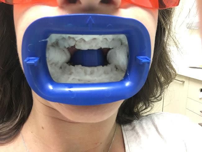 The very selfie-friendly mouthguard used in the whitening process. (Goodbye, dignity). Photo: Supplied