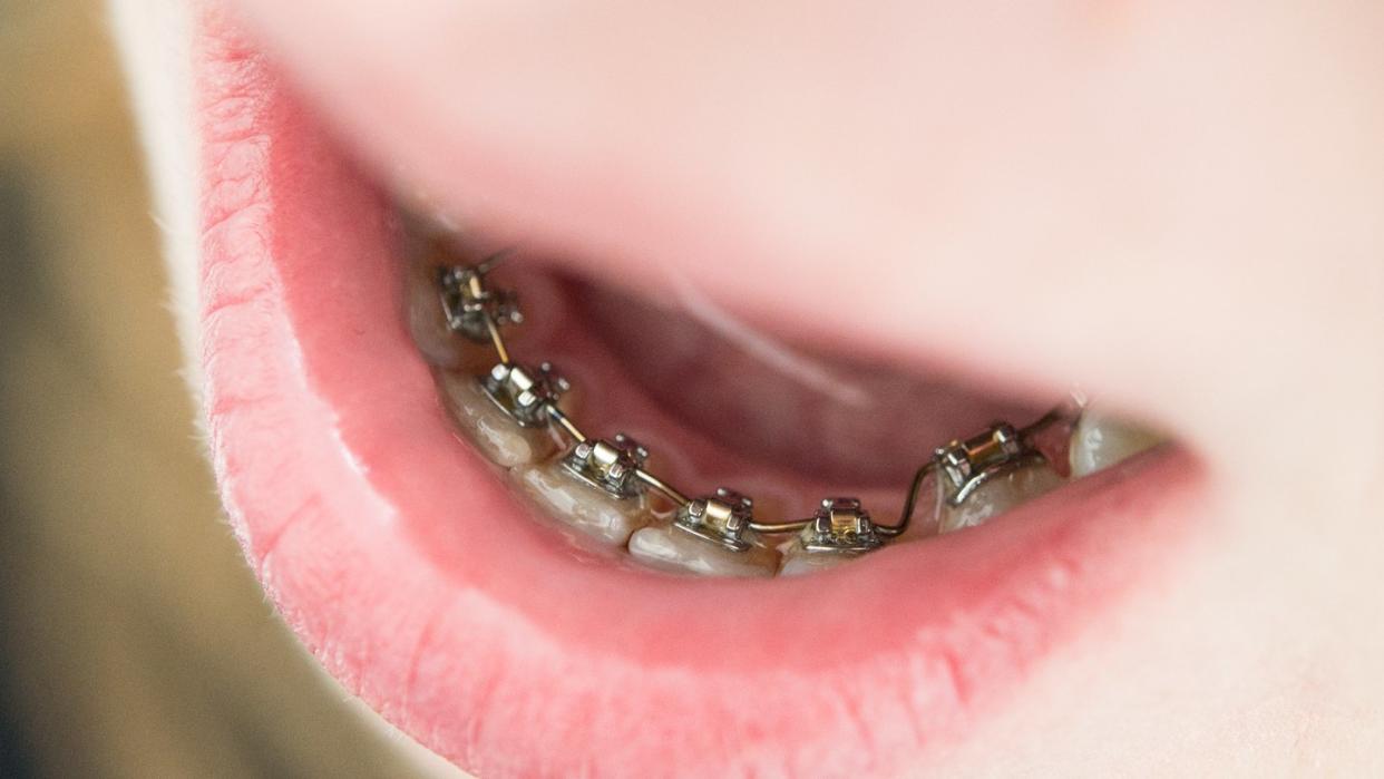 Haben Eltern Zweifel, ob eine Zahnspange für ihr Kind wirklich sinnvoll ist, sollten sie sich von einem anderen Kieferorthopäden eine Zweitmeinung einholen. Foto: Franziska Gabbert