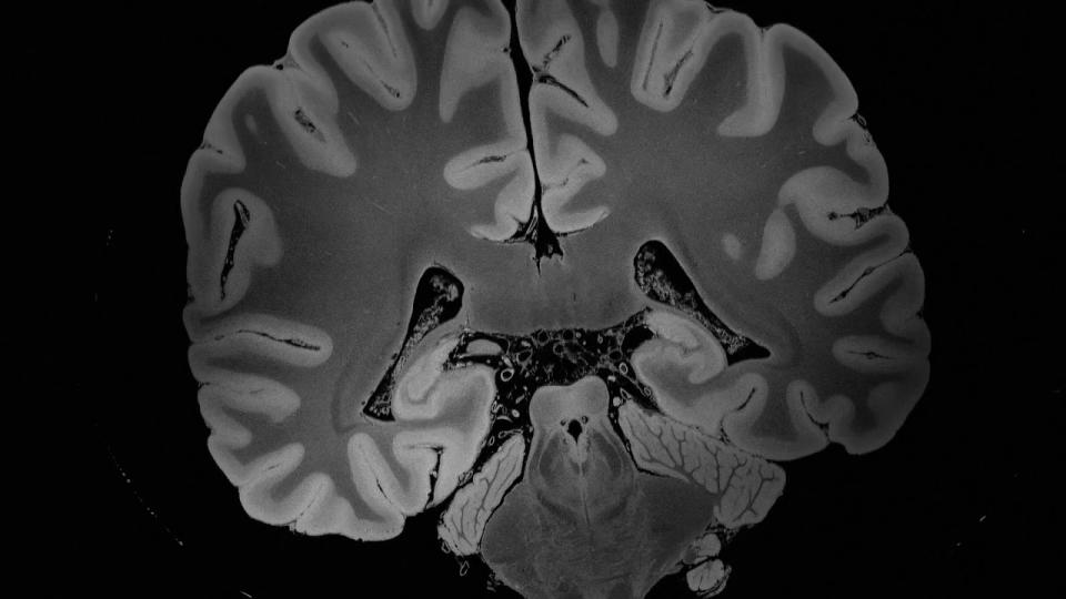 Las imágenes captadas gracias a una resonancia magnética durante casí cinco días nos ofrecen detalles del cerebro con gran precisión | Edlow, Brian L., et al. 