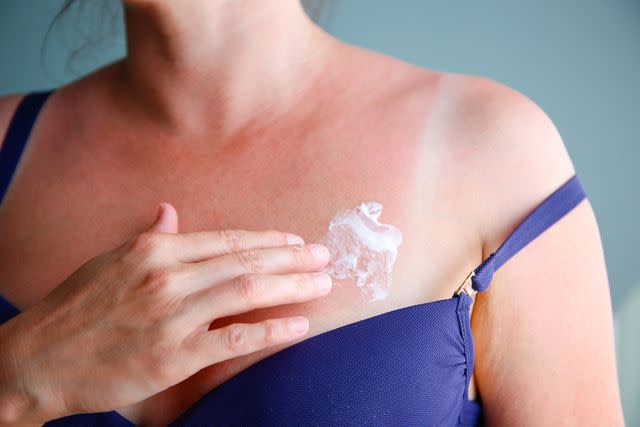 <p>Getty</p> Stock image of a woman treating her sunburned skin.