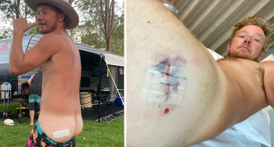Left, Daniel can be seen gesturing the 'shaka' while exposing the wound on his bum. Right, Daniel shows his wound in hospital after surgeons removed a nail from his bum.
