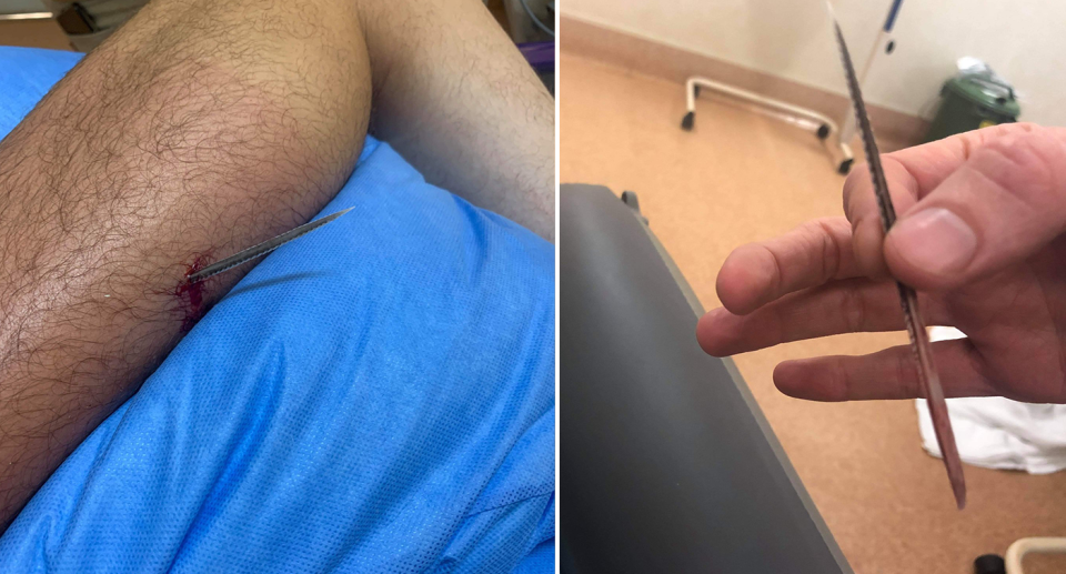 Left - a barb in Liam Richards' leg. Right - someone holding the barb once it was removed.