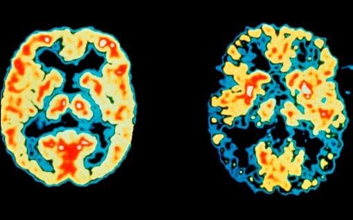 The scan on the right shows reduction of both function and blood flow in both sides of the brain, a feature often seen in Alzheimer's. - Credit: DR ROBERT FRIEDLAND/SCIENCE PHOTO LIBRARY