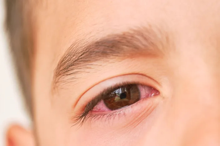 Some doctors say XBB.1.16 may be causing a new symptom among children: conjunctivitis. (Getty Images)