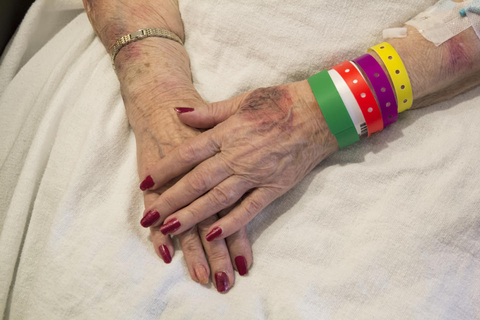 Bruised Hands of Elderly Woman in Emergency Room