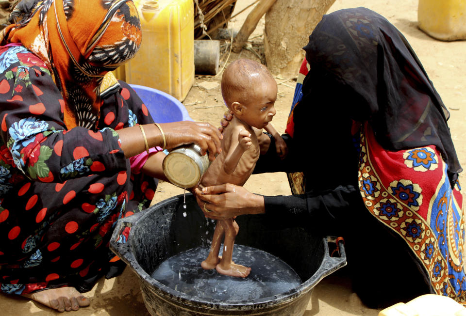 In this Aug. 25, 2018 photo, a severely malnourished infant is bathed in a bucket in Aslam, Hajjah, Yemen. Yemen’s civil war has wrecked the impoverished country’s already fragile ability to feed its population. Around 2.9 million women and children are acutely malnourished; another 400,000 children are fighting for their lives only a step away from starvation. (AP Photo/Hammadi Issa)