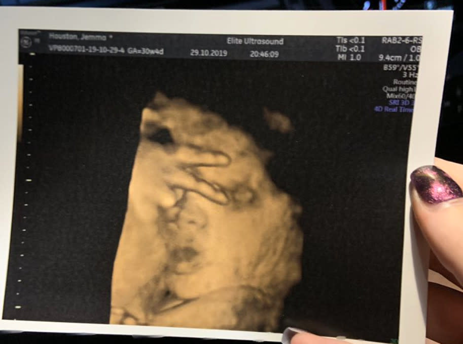 潔瑪日前在醫院接受超音波掃描，竟發現未出生的女兒手比YA遮住了小臉，讓她看了感到驚喜卻又抱怨得再跑一趟照超音波。（圖片翻攝Twitter/Jemma Houston）