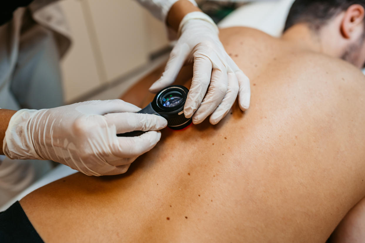 Doctor examines a male patient's back for signs of skin cancer. (Getty Images)