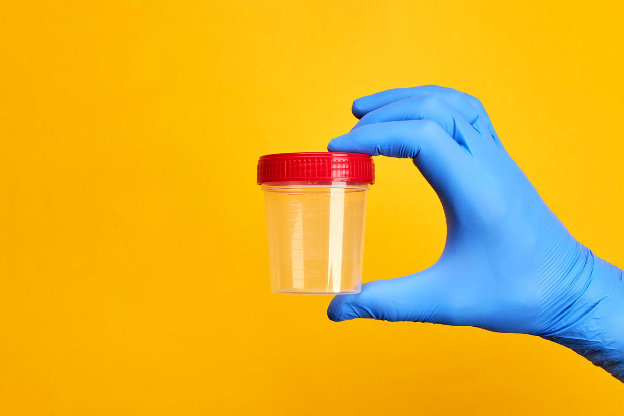 Medical examiner holding urine cup Getty Images/Andrii Atanov