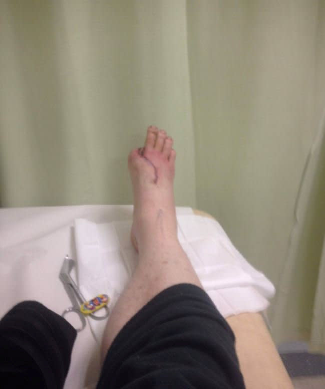 Surgeons removed David's right big toe and attached it to his hand so he can work again (Picture: SWNS)