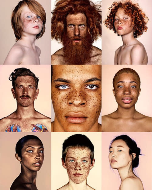 The photo series #Freckles celebrates the beauty of spots