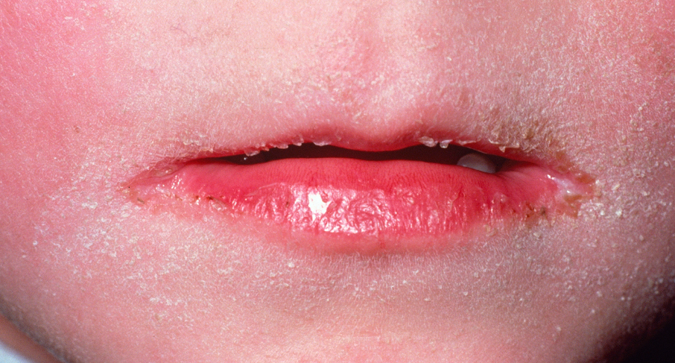 Strep throat can also lead to scarlet fever in some cases. Source: Getty 