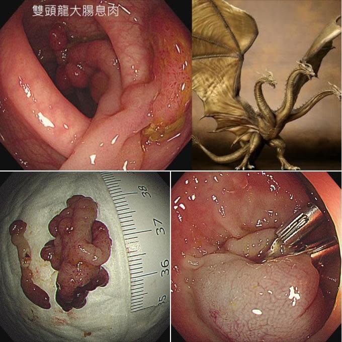林相宏醫師分享發現並切除雙頭龍息肉的照片，並提供可以開始做大腸鏡檢查的年齡建議。（翻攝林相宏醫師臉書）