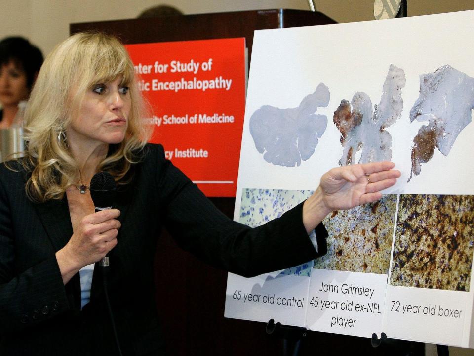 Dr. Ann McKee, of Boston University School of Medicine, has found chronic traumatic encephalopathy (CTE) in the brains of 90 former pro football players. (Photo: AP)