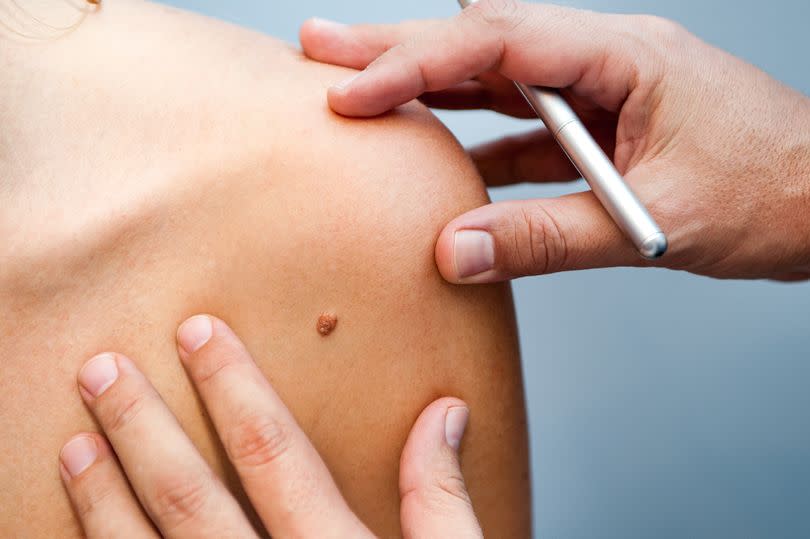 A medical consultation doctor looking at mole