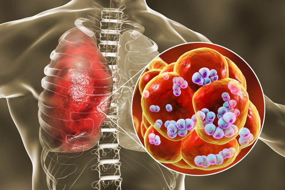 Streptococcus pneumoniae