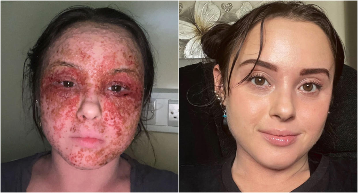Beatrice Guaca began experiencing extreme eczema flare-ups after she switched to a healthy diet. (Caters)