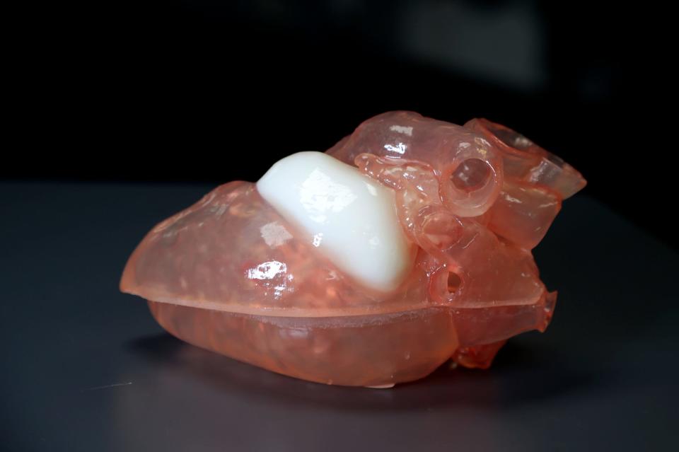Materialise manufactured a flexible 3D model of the heart of a 16-year-old boy with a cardiac tumor. The model helped doctors at Cincinnati Children’s Hospital decide the best course of treatment for the boy. Once they saw on the model that there wouldn’t be enough structural heart tissue if they removed the tumor during an open-heart surgery, they instead opted for a catheter ablation. The model was displayed on Sept. 14, 2023, at the company’s Plymouth Township 3D printing facility where it was made several years earlier.