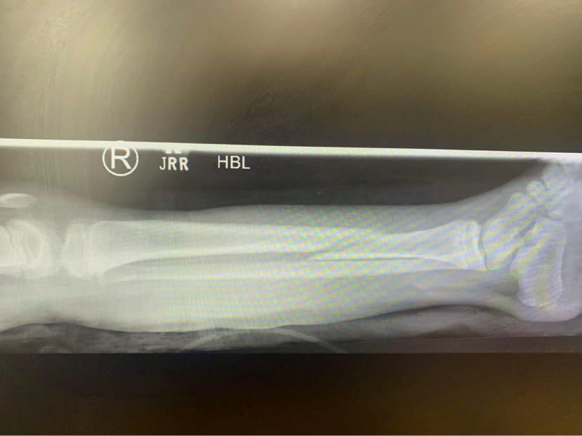 An x-ray of Millie Schofield's broken leg. (SWNS)